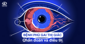 Bệnh phù gai thị giác: Chẩn đoán và điều trị