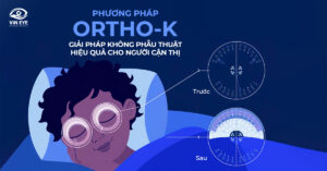 Phương pháp Ortho-K Là Gì?