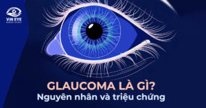 Glaucoma là gì? Nguyên nhân và triệu chứng của cườm nước