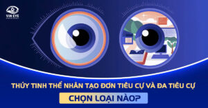Thủy tinh thể nhân tạo đơn tiêu cự và đa tiêu cự: Chọn loại nào?